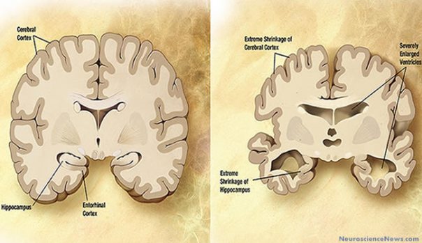 Healthy Brain vs. Alzheimer’s Brain